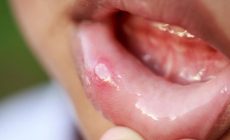 5 Hal yang Bisa Memicu Timbulnya Sariawan di Mulut